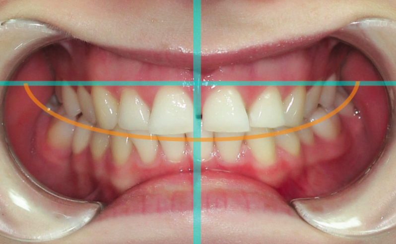 Top 5 Smile Design Trends, Explained by a Leading London Dentist 1 smile design 5